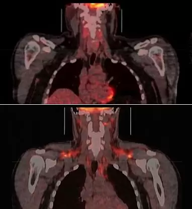 PET-CT of brown fat activation.